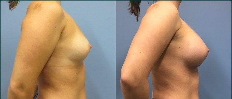 Breast augmentation before and after, female patient, case BAU-L02, Dr Rohit Kumar, Sydney