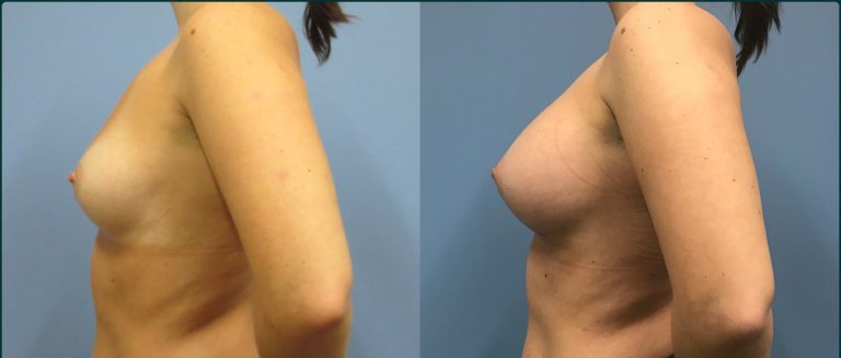 Breast augmentation before and after, female patient, case BAU-L02, Dr Rohit Kumar, Sydney