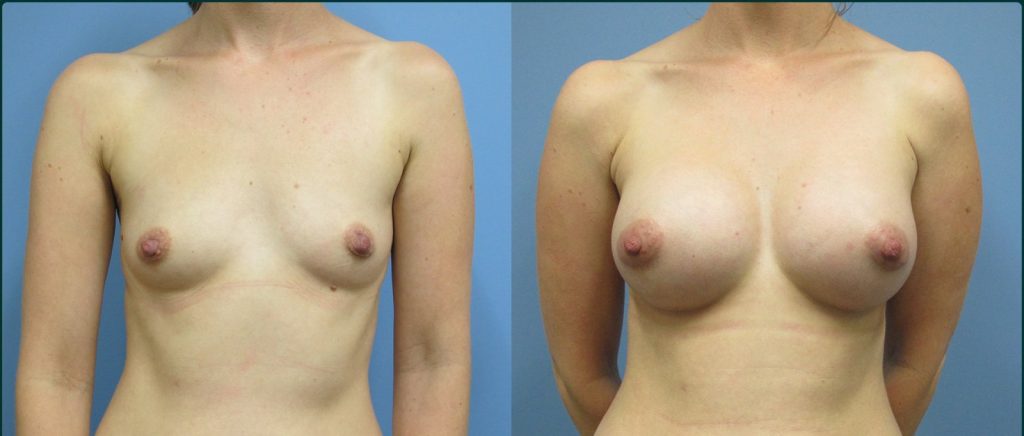 Breast augmentation before and after, female patient, case BAU-L03, Dr Rohit Kumar, Sydney