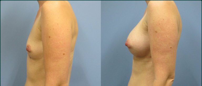 Breast augmentation before and after, female patient, case BAU-L03, Dr Rohit Kumar, Sydney