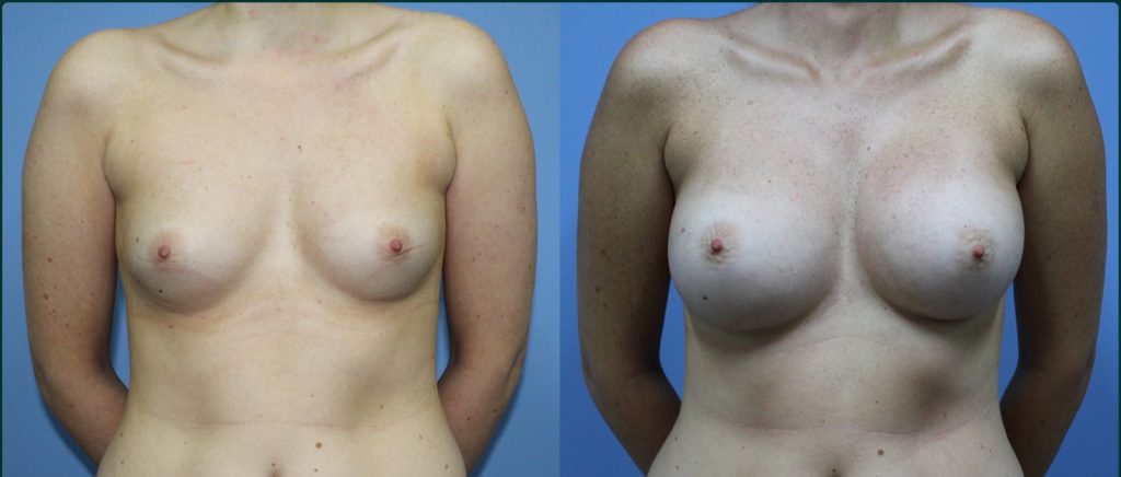 Breast augmentation before and after, female patient, case BAU-L04, Dr Rohit Kumar, Sydney