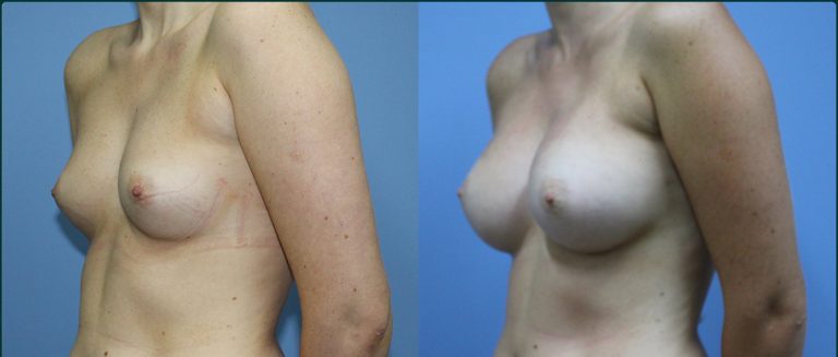 Breast augmentation before and after, female patient, case BAU-L04, Dr Rohit Kumar, Sydney