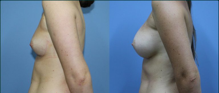 Breast augmentation before and after, female patient, case BAU-L04, Dr Rohit Kumar, Sydney
