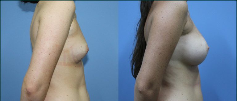 Breast augmentation before and after, female patient, case BAU-L04, Dr Rohit Kumar, Sydney
