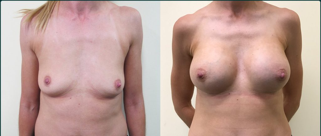 Breast augmentation before and after, female patient, case BAU-L05, Dr Rohit Kumar, Sydney