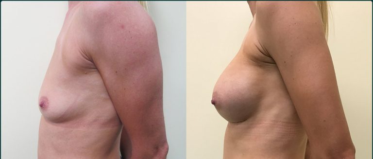 Breast augmentation before and after, female patient, case BAU-L05, Dr Rohit Kumar, Sydney