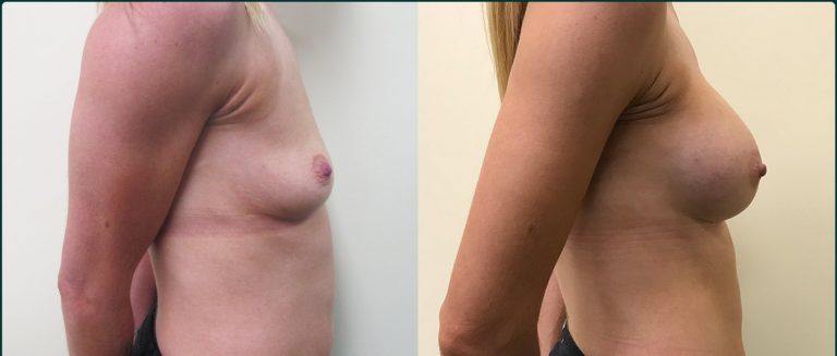 Breast augmentation before and after, female patient, case BAU-L05, Dr Rohit Kumar, Sydney