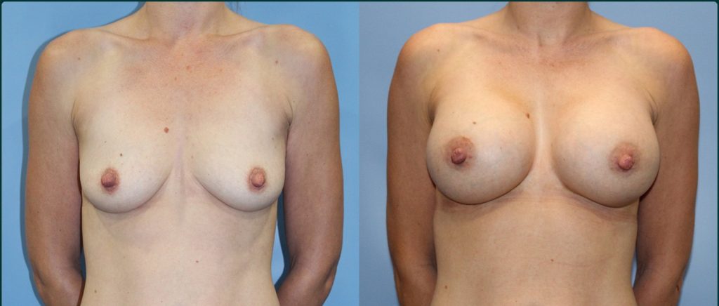 Breast augmentation before and after, female patient, case BAU-L06, Dr Rohit Kumar, Sydney
