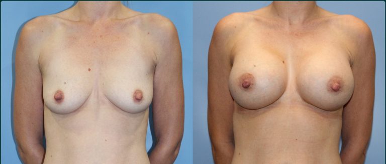 Breast augmentation before and after, female patient, case BAU-L06, Dr Rohit Kumar, Sydney