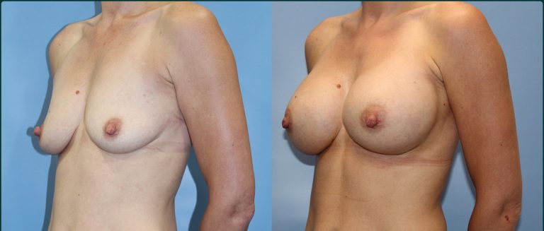 Breast augmentation before and after, female patient, case BAU-L06, Dr Rohit Kumar, Sydney