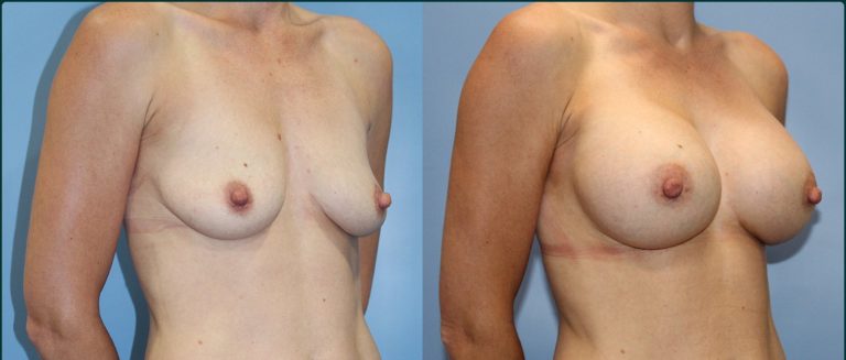 Breast augmentation before and after, female patient, case BAU-L06, Dr Rohit Kumar, Sydney