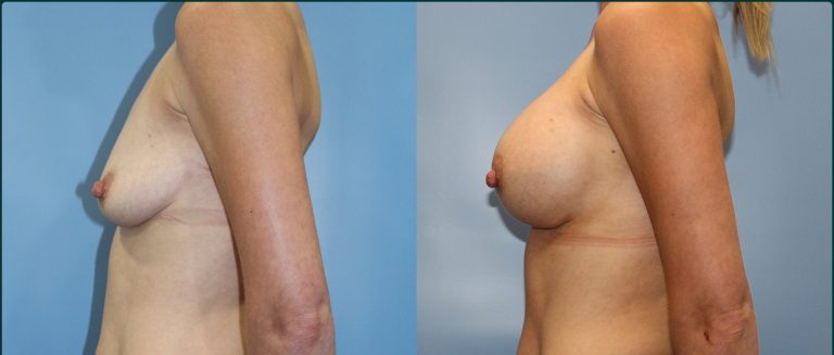 Breast augmentation before and after, female patient, case BAU-L06, Dr Rohit Kumar, Sydney
