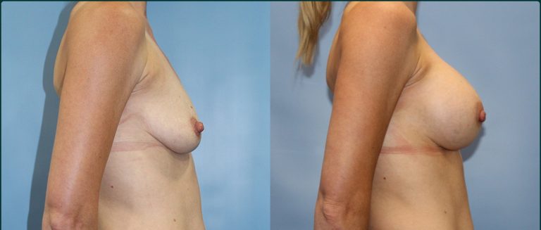 Breast augmentation before and after, female patient, case BAU-L06, Dr Rohit Kumar, Sydney