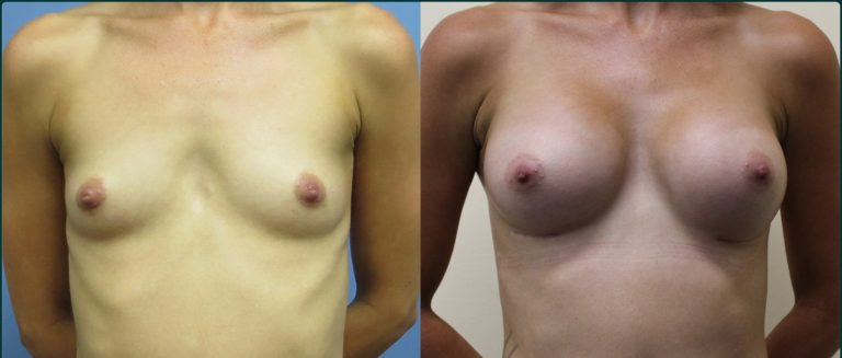 Breast augmentation before and after, female patient, case BAU-L07, Dr Rohit Kumar, Sydney
