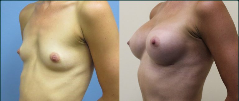 Breast augmentation before and after, female patient, case BAU-L07, Dr Rohit Kumar, Sydney