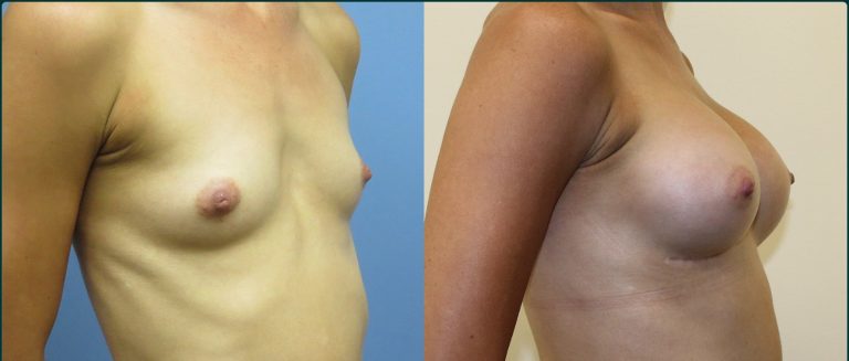 Breast augmentation before and after, female patient, case BAU-L07, Dr Rohit Kumar, Sydney