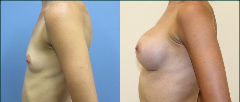 Breast augmentation before and after, female patient, case BAU-L07, Dr Rohit Kumar, Sydney