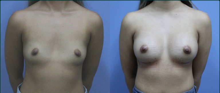 Breast augmentation before and after, female patient, case BAU-L08, Dr Rohit Kumar, Sydney