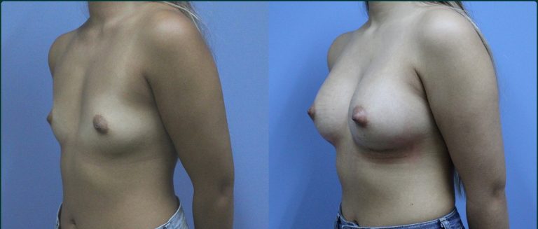 Breast augmentation before and after, female patient, case BAU-L08, Dr Rohit Kumar, Sydney