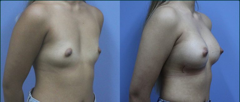 Breast augmentation before and after, female patient, case BAU-L08, Dr Rohit Kumar, Sydney