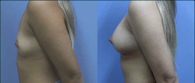 Breast augmentation before and after, female patient, case BAU-L08, Dr Rohit Kumar, Sydney
