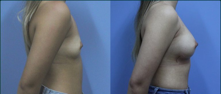 Breast augmentation before and after, female patient, case BAU-L08, Dr Rohit Kumar, Sydney