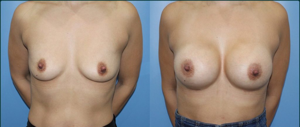 Breast augmentation before and after, female patient, case BAU-L09, Dr Rohit Kumar, Sydney
