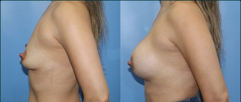 Breast augmentation before and after, female patient, case BAU-L09, Dr Rohit Kumar, Sydney
