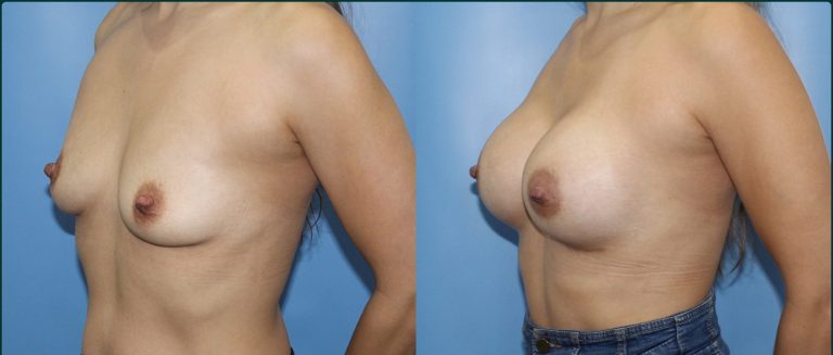 Breast augmentation before and after, female patient, case BAU-L09, Dr Rohit Kumar, Sydney
