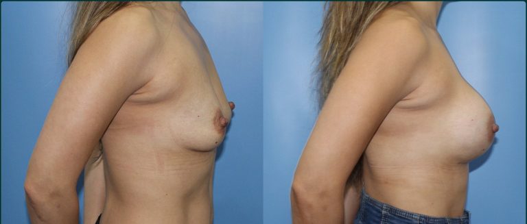 Breast augmentation before and after, female patient, case BAU-L09, Dr Rohit Kumar, Sydney