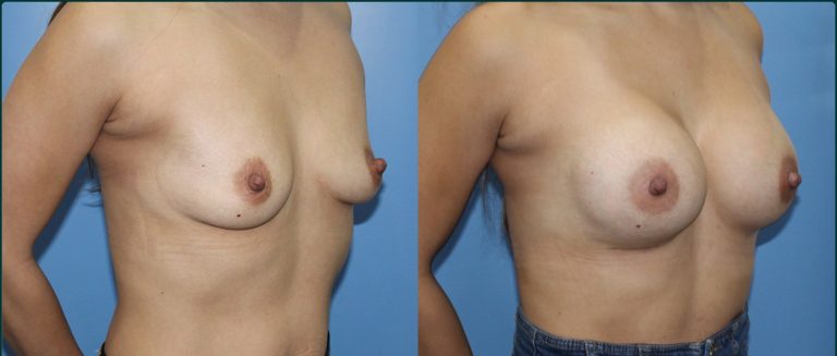 Breast augmentation before and after, female patient, case BAU-L09, Dr Rohit Kumar, Sydney