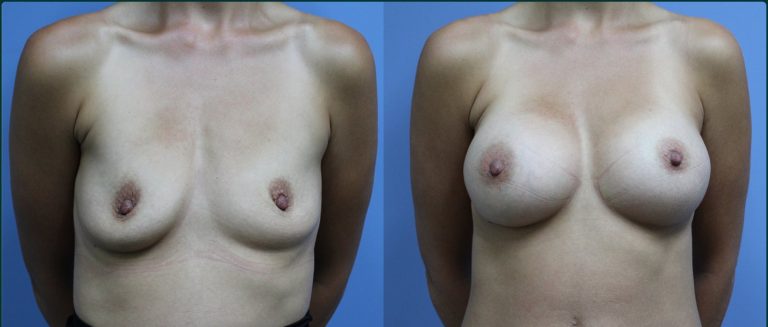 Breast augmentation before and after, female patient, case BAU-L10, Dr Rohit Kumar, Sydney