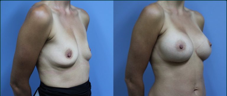 Breast augmentation before and after, female patient, case BAU-L10, Dr Rohit Kumar, Sydney
