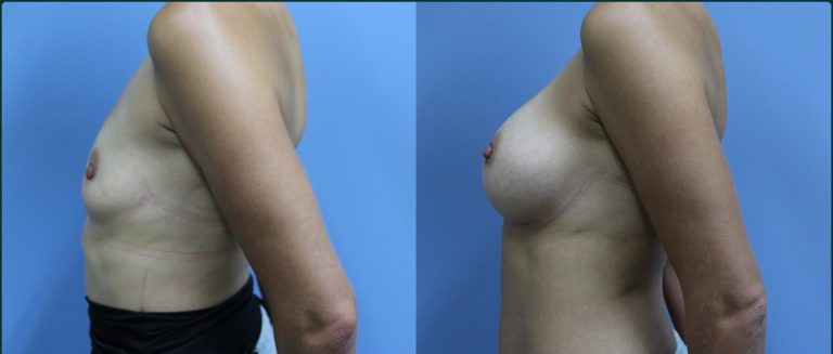 Breast augmentation before and after, female patient, case BAU-L10, Dr Rohit Kumar, Sydney