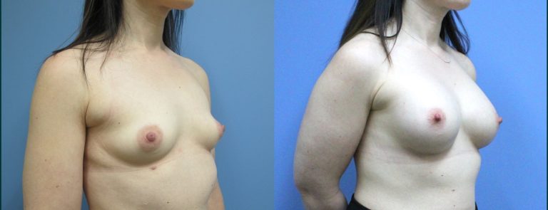 Breast augmentation before and after, female patient, case BAU-L11, Dr Rohit Kumar, Sydney