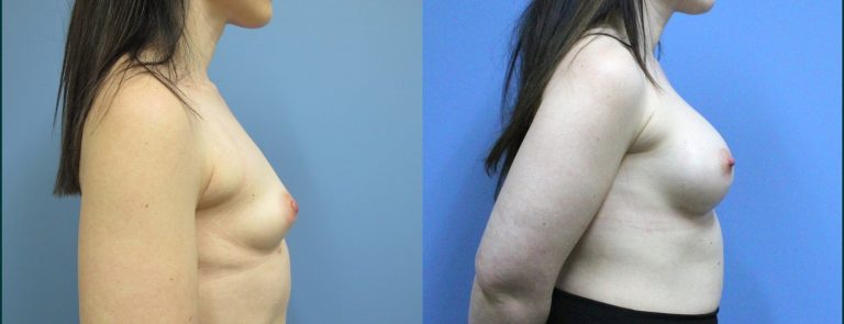 Breast augmentation before and after, female patient, case BAU-L11, Dr Rohit Kumar, Sydney