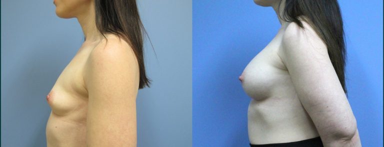 Breast augmentation before and after, female patient, case BAU-L11, Dr Rohit Kumar, Sydney