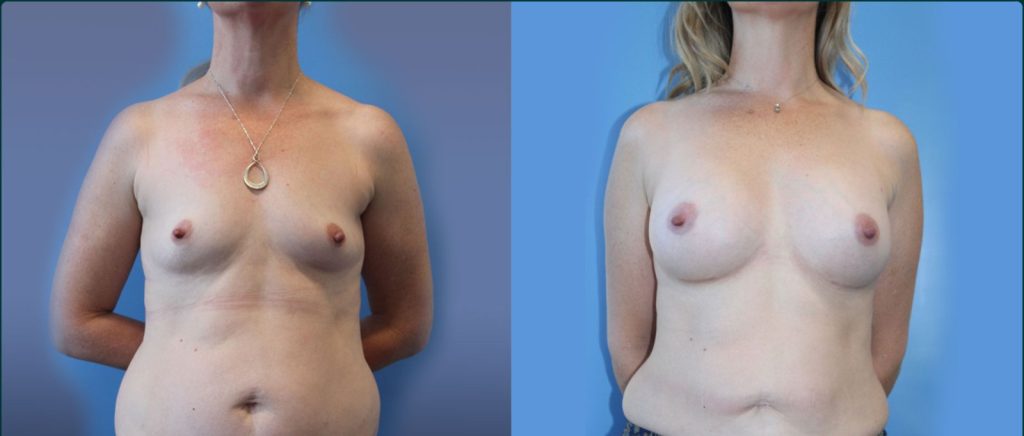 Breast augmentation before and after, female patient, case BAU-L12, Dr Rohit Kumar, Sydney