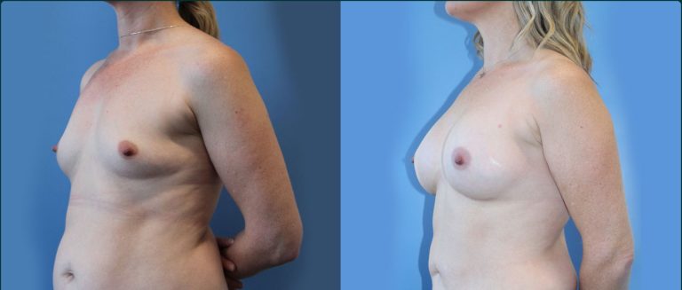 Breast augmentation before and after, female patient, case BAU-L12, Dr Rohit Kumar, Sydney