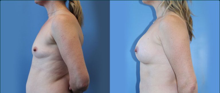 Breast augmentation before and after, female patient, case BAU-L12, Dr Rohit Kumar, Sydney