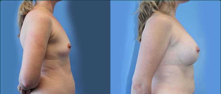 Breast augmentation before and after, female patient, case BAU-L12, Dr Rohit Kumar, Sydney
