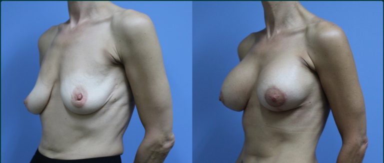 Breast lift with implants (augmentation mastopexy) before and after, 45° left view, female patient, case BLA-L01, Dr Rohit Kumar, Sydney