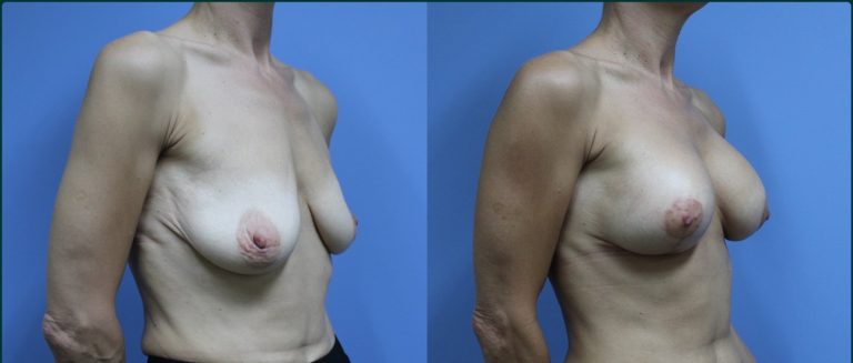 Breast lift with implants (augmentation mastopexy) before and after, 45° right view, female patient, case BLA-L01, Dr Rohit Kumar, Sydney