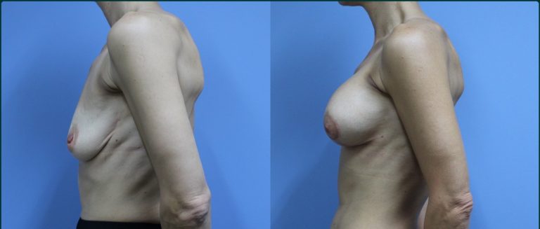 Breast lift with implants (augmentation mastopexy) before and after, 90° left view, female patient, case BLA-L01, Dr Rohit Kumar, Sydney