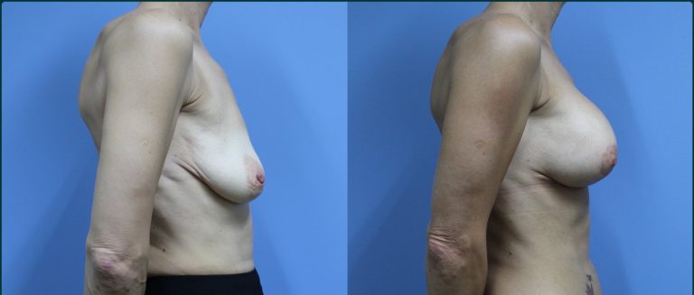 Breast lift with implants (augmentation mastopexy) before and after, 90° right view, female patient, case BLA-L01, Dr Rohit Kumar, Sydney