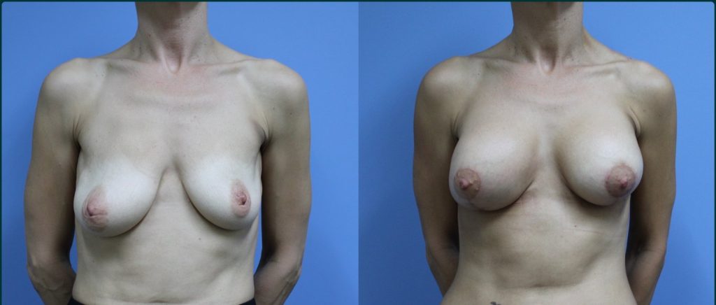 Breast lift with implants (augmentation mastopexy) before and after, front view, female patient, case BLA-L01, Dr Rohit Kumar, Sydney