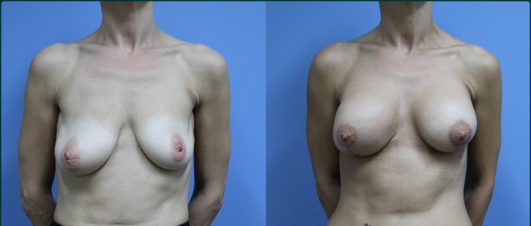 Breast lift with implants (augmentation mastopexy) before and after, front view, female patient, case BLA-L01, Dr Rohit Kumar, Sydney