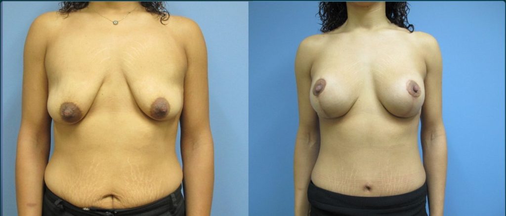 Breast lift with implants (augmentation mastopexy) before and after, female patient, case BLA-L02, Dr Rohit Kumar, Sydney