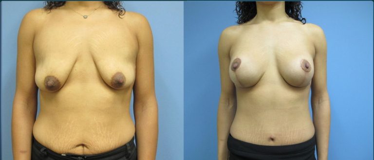 Breast lift with implants (augmentation mastopexy) before and after, female patient, case BLA-L02, Dr Rohit Kumar, Sydney