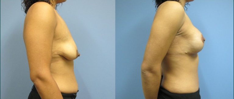 Breast lift with implants (augmentation mastopexy) before and after, female patient, case BLA-L02, Dr Rohit Kumar, Sydney